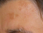 Melasma der Stirn